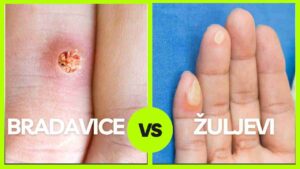Bradavice ili Zuljevi
